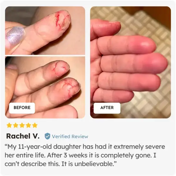 Before and after comparison of a child's foot after using Skinesa Kids from verified user Rachel 