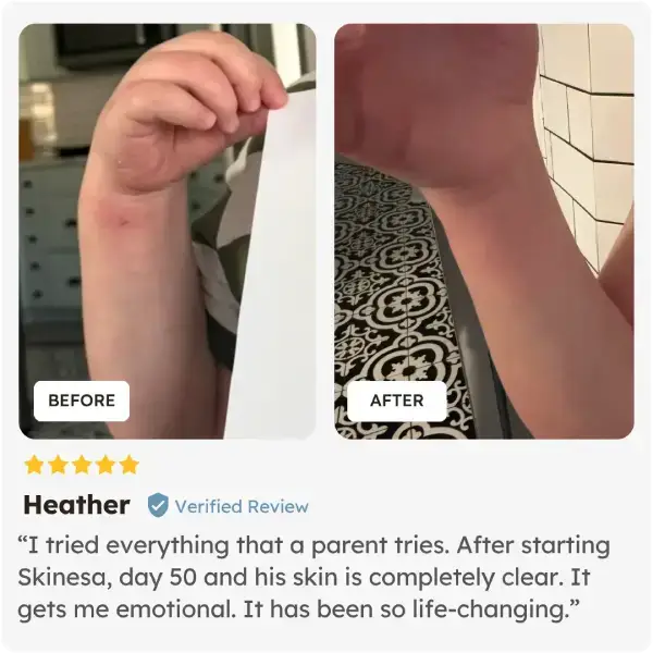 Before and after comparison of a child's skin with text and a verified review after using Skinesa Kids.