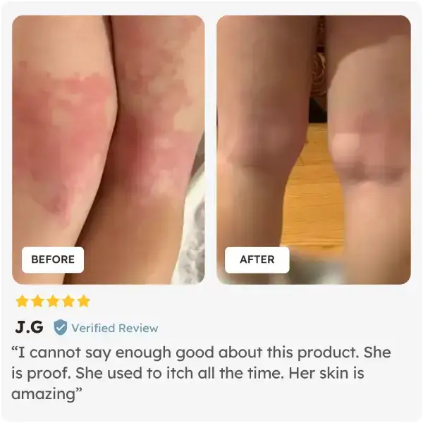 Before and after comparison of skin on a child's leg with a five-star review after using Skinesa Kids Chewables
