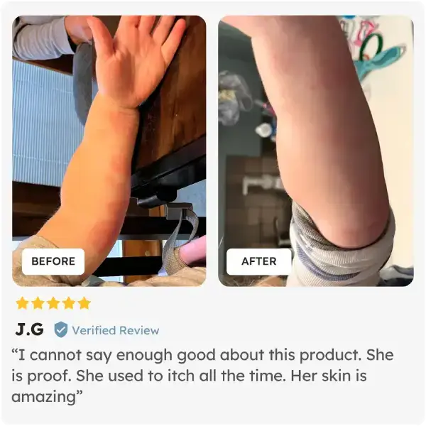Before and after comparison of a child's arm after using Skinesa Kids 