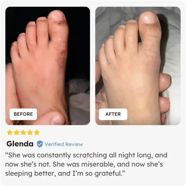 Before and after comparison of a child's foot after using Skinesa Kids from verified user Glenda