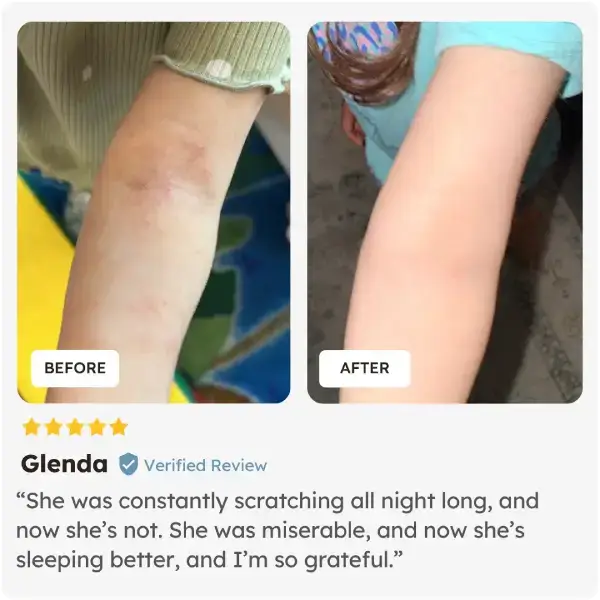 Before and after comparison of a child's arms after using Skinesa Kids from verified user Glenda