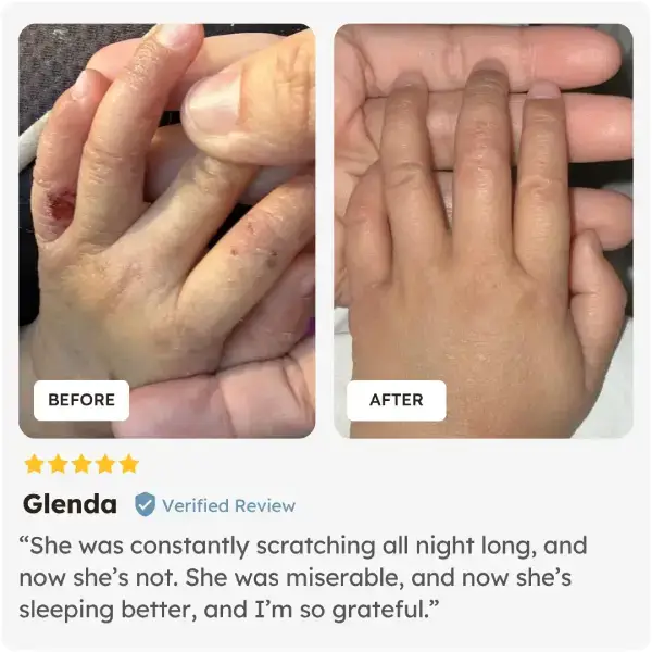 Before and after comparison of a child's arm with visible improvement, shown with a five-star review from Glenda who used Skinesa Kids.