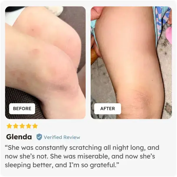 Before and after comparison of a child's arm with visible improvement, shown with a five-star review from Glenda who used Skinesa Kids.