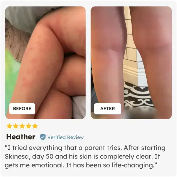 Before and after comparison of a child's skin with a positive review from Heather who uses Skinesa Kids chewables
