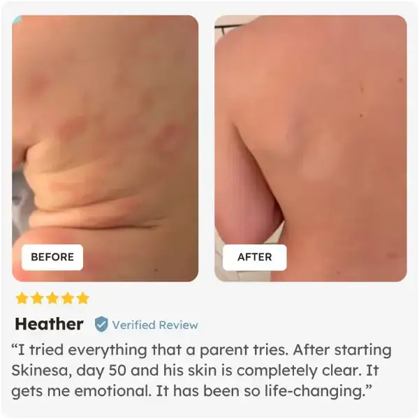 Before and after comparison of skin on a child's arm with a five-star review from Heather who used Skinesa Kids Chewables