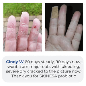 Skinesa daily probiotic supplement for skin testimonial